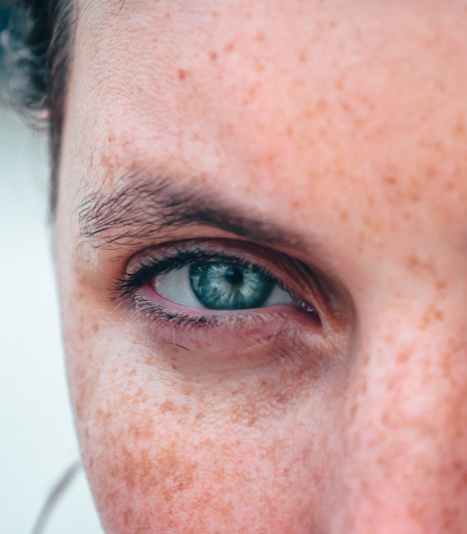 Close-up of a person's eye with visible freckles and skin texture.